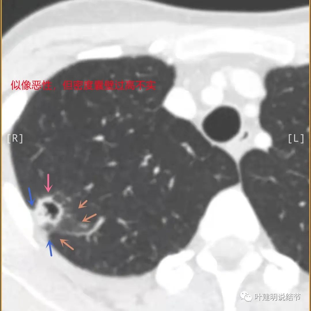临床诊断孤立性肺结节,空洞型结节一般是什么性质