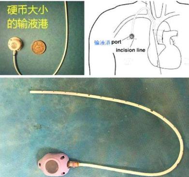 脑血管核磁共振具体检查过程,脑血管核磁共振前要注意什么