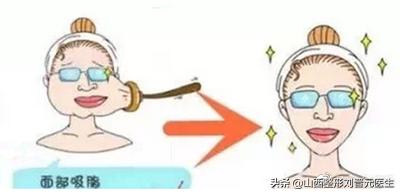 面部吸脂粘连后如何快速恢复,面部吸脂恢复视频