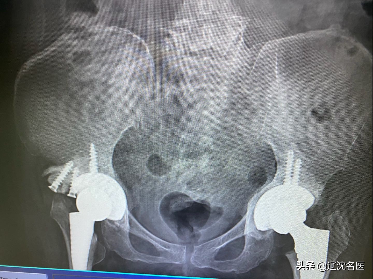 股骨头坏死置换后遗症,股骨头坏死吃止痛片有用吗