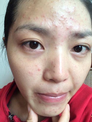 脸上痘痘很红怎么办,脸上长了一个很硬很痛的痘痘
