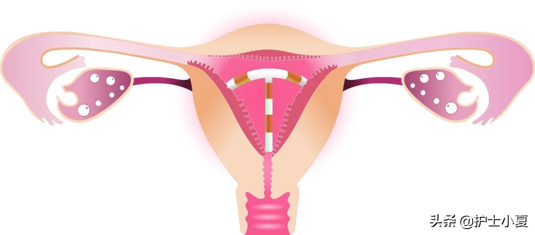 节育环可以终身不取,节育环可以终身不取出来吗