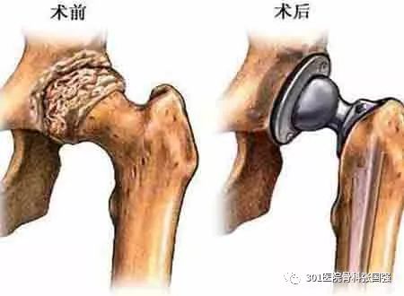 先天性髋关节脱位可以顺产吗,先天性髋关节脱位手术费多少