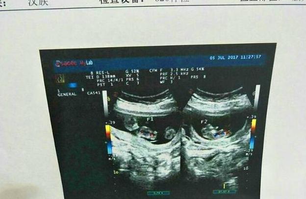 单胎变双胞胎能变成龙凤胎吗,两个月了双胎变成单胎的几率