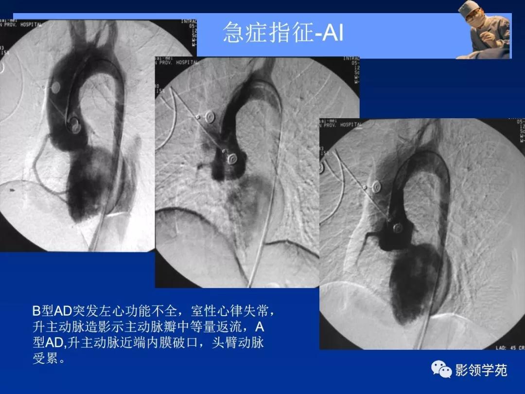 主动脉夹层壁间血肿如何鉴别,主动脉夹层血肿溃疡