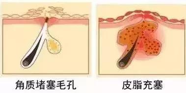 闭口粉刺痘痘黑头白头的区别,开口粉刺和闭口怎么区分
