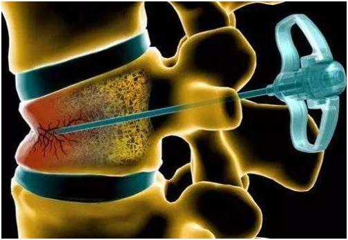 啤酒和白酒哪个对骨头伤害大,酒精对骨头的危害的视频