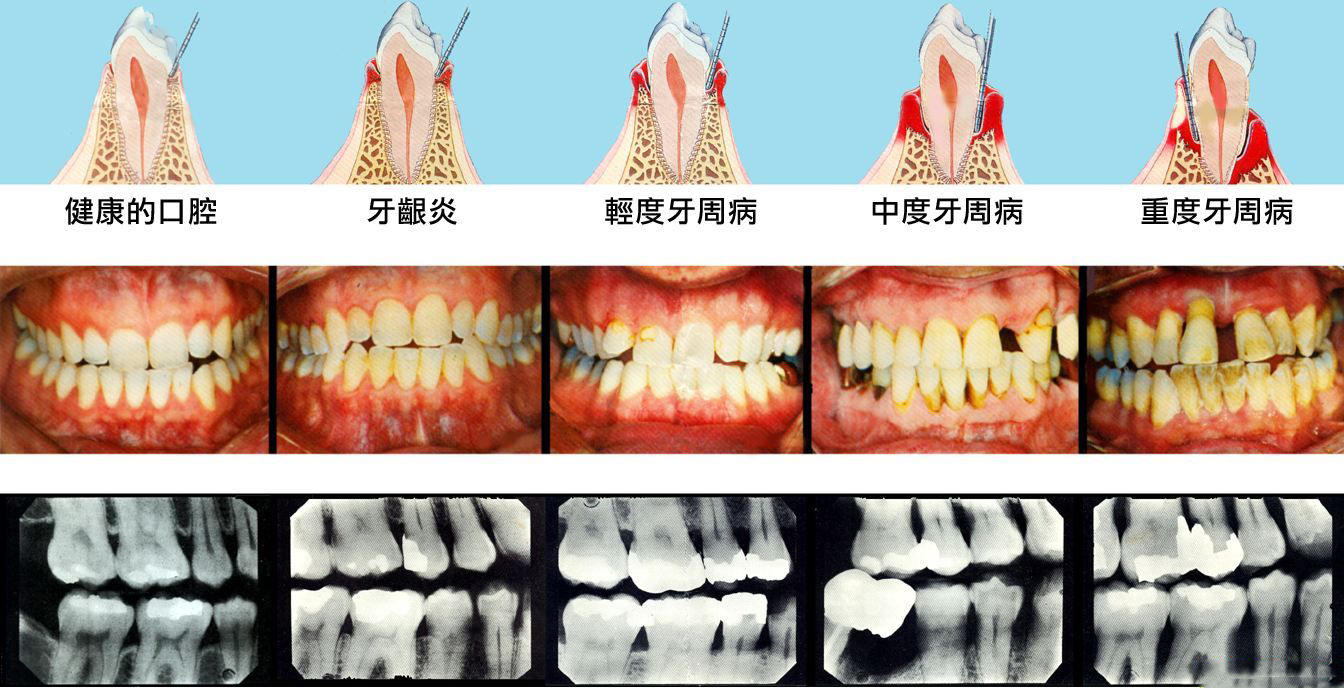 年纪轻轻的掉牙齿是怎么回事,年纪轻轻牙齿掉了