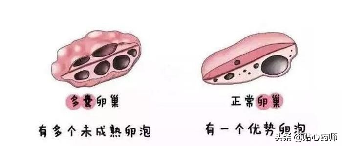 月经不调是不是长小胡子,月经不规律可能患有什么疾病