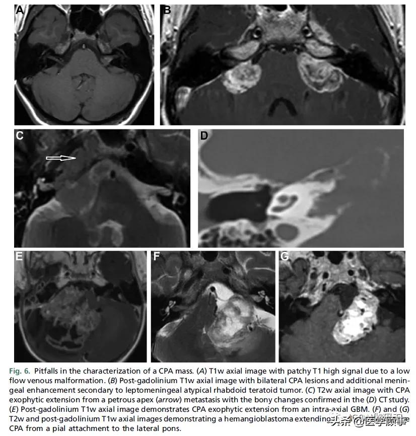 「综述」前庭神经鞘瘤的成像：诊断、监测、和治疗计划