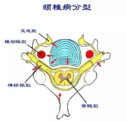 颈椎病不能推拿按摩的类型,按摩不当致瘫痪