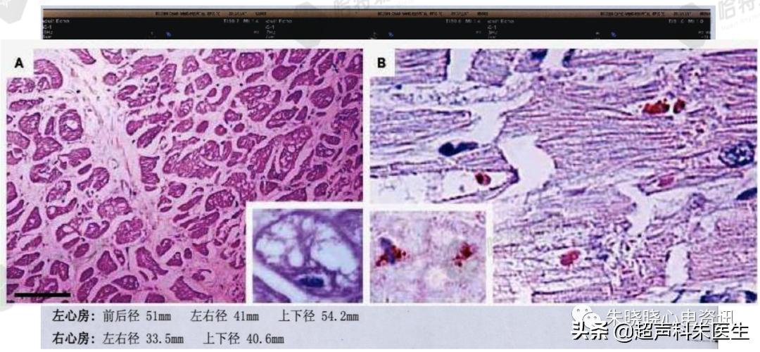t波倒置诊断,t波倒置如何区分严重程度