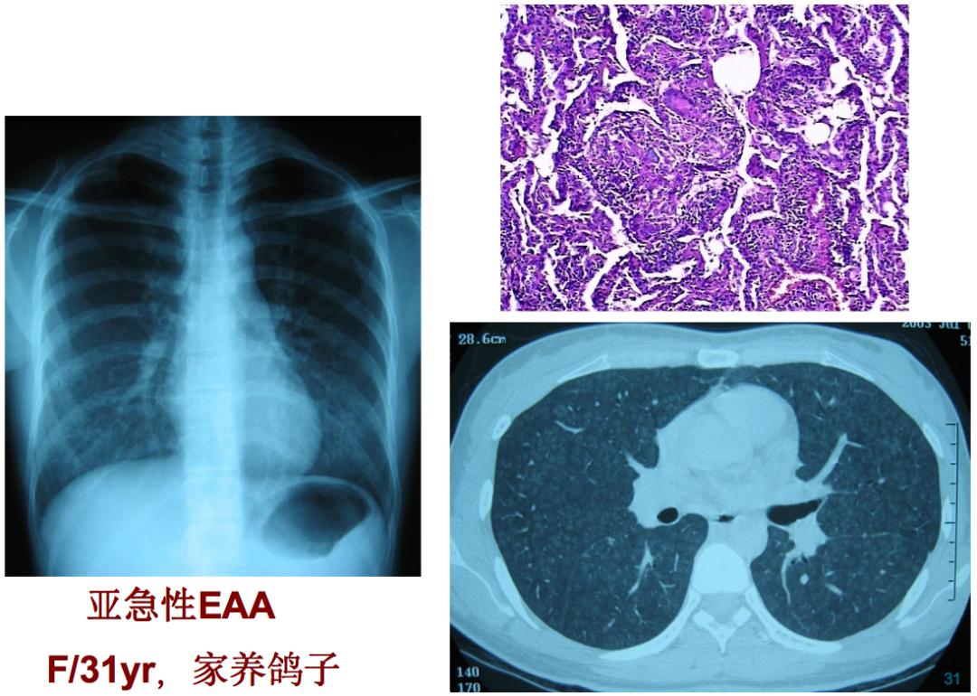 养鸽子造成皮肤真菌感染,养鸽子会得肺炎吗