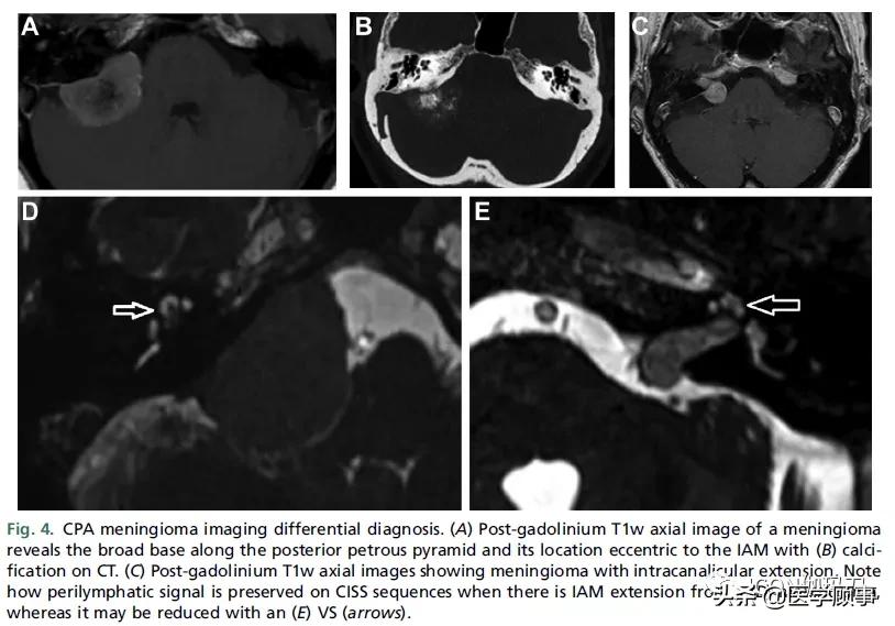 「综述」前庭神经鞘瘤的成像：诊断、监测、和治疗计划