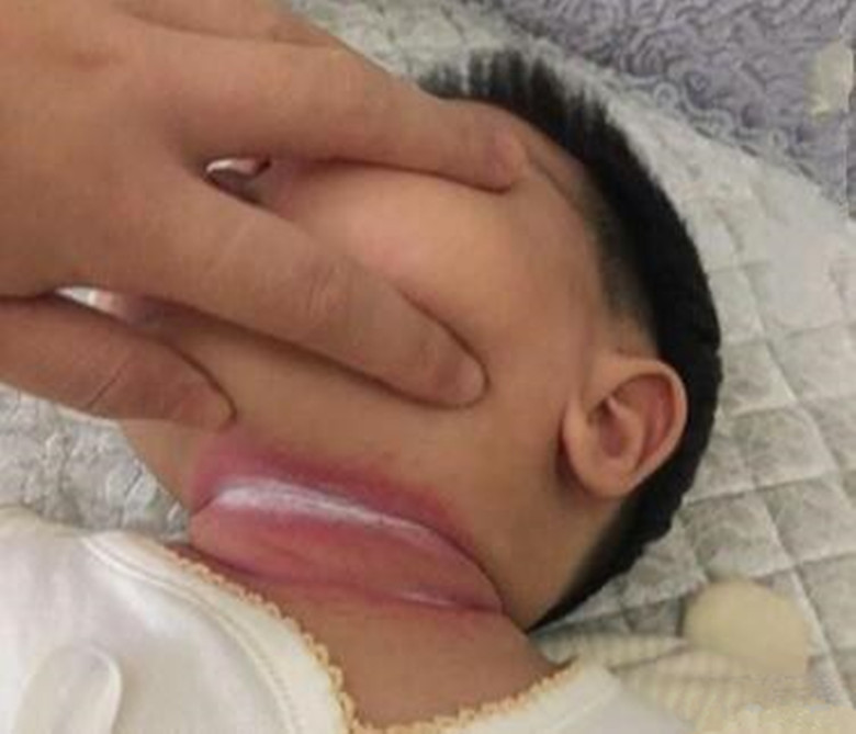 新生儿淹脖子发红怎么处理,宝宝淹脖子发红起疹子怎么办