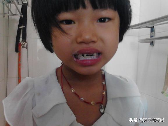 小孩蛀牙疼痛可以补牙吗,小孩蛀牙痛怎么缓解最有效