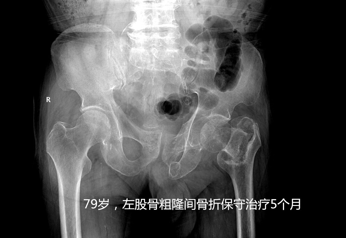 人生最后一次骨折原因,人生的最后一次骨折