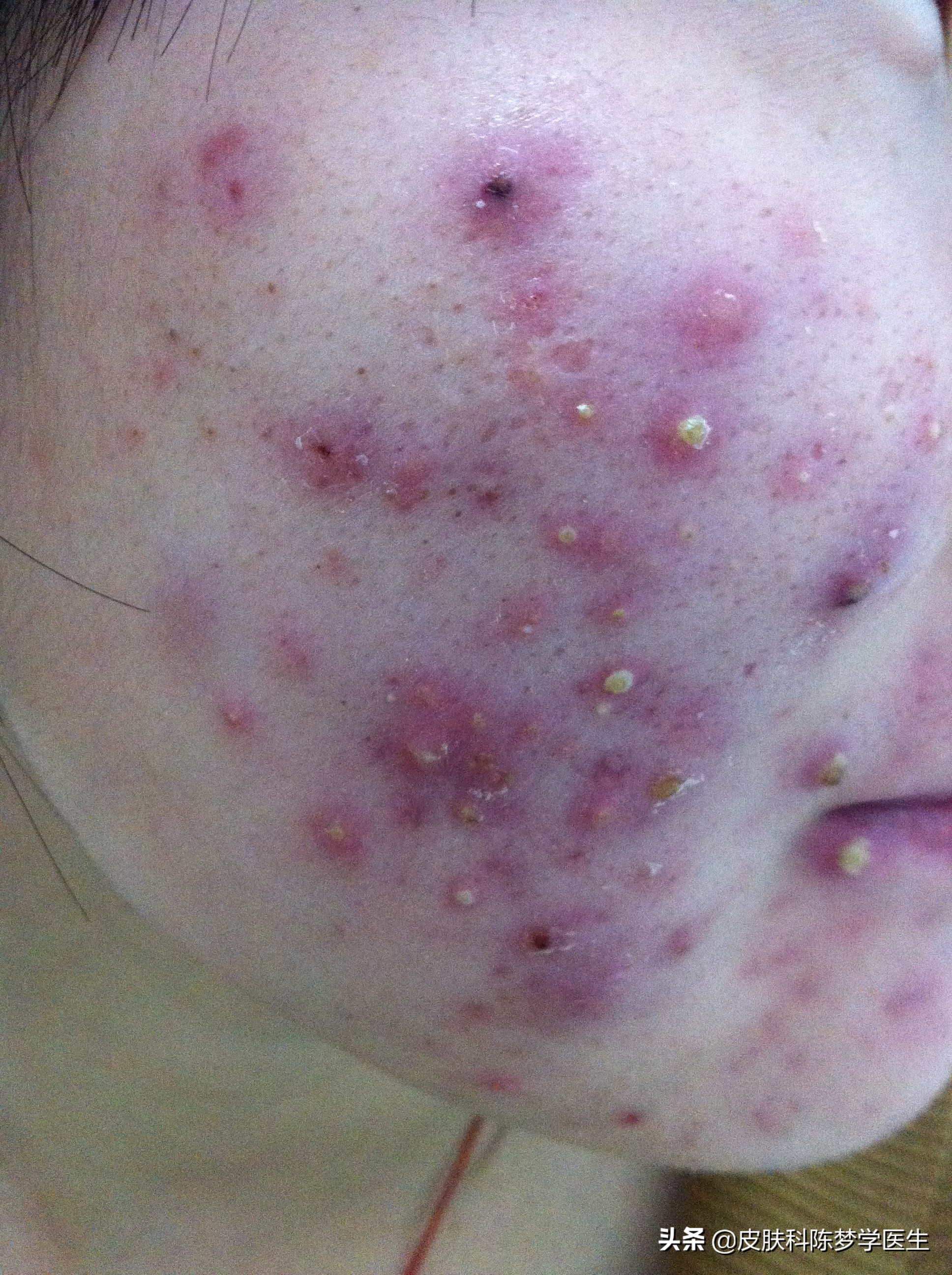 青春痘首选治疗方案是什么？答案都在这里了