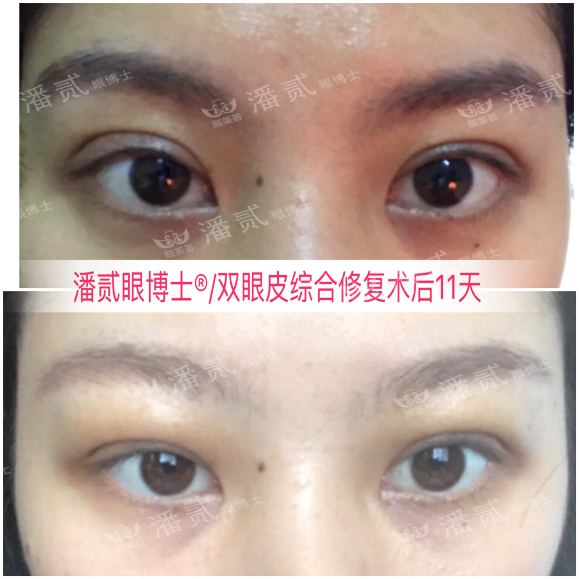 肿眼泡抽脂肪埋线双眼皮效果,肿眼泡割双眼皮长脂肪