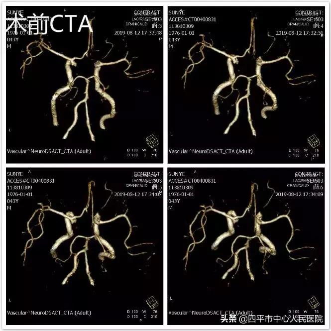 精准排雷再现新高—神经外科在6月份成功救治6例颅内动脉瘤患者