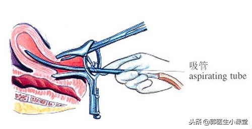 去医院会知道自己以前做过人流吗,以前做过人流可以不告诉医生吗