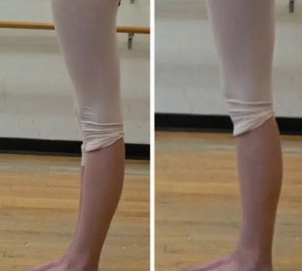 如何拯救腿型,麒麟腿