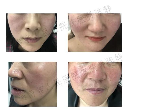 过敏脸上身上全是红痘痘,脸红就是玫瑰痤疮吗