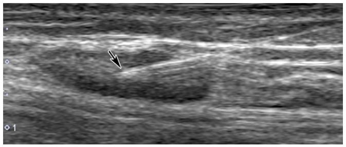 盆腔囊肿复发,盆腔淋巴管囊肿