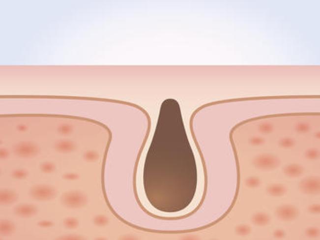毛孔粗大如何改善真实有效,毛孔粗大收缩毛孔最科学的方法
