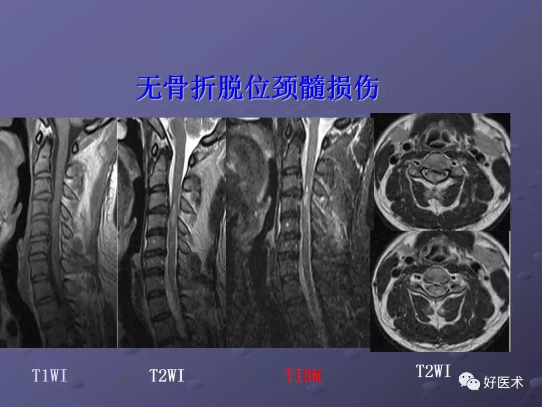 脊柱mri有哪些特点,乳腺疾病的mri诊断及鉴别