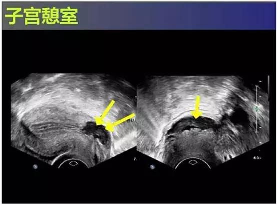 子宫憩室后遗症有哪些,子宫憩室手术治疗有哪些危害