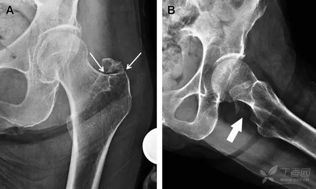 值夜班急救措施,放射科容易漏诊的骨折