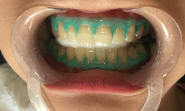 美白牙齿冷光仪真的靠谱,牙齿美白修复你真的可以了解一点