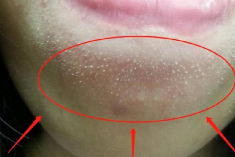 下巴处长很多小颗粒是怎么回事,下巴小颗粒一抠一个洞