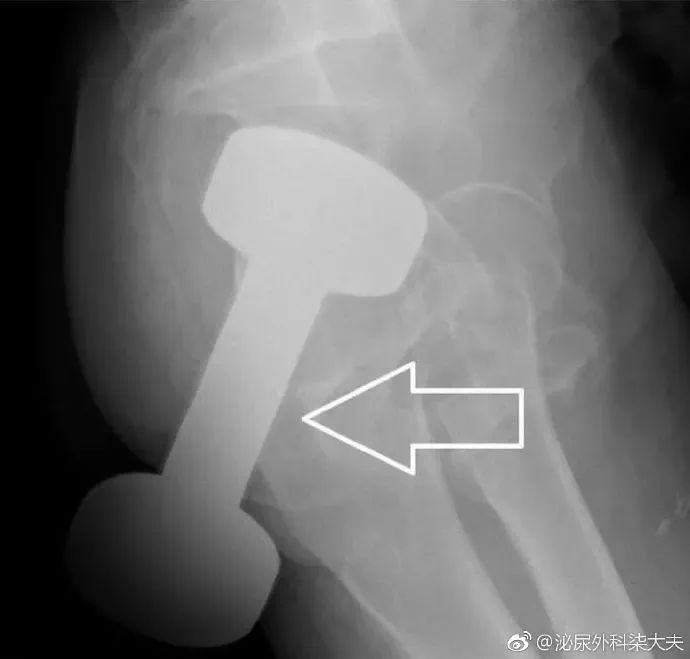 一条罗非鱼“游”进肛门?医生:直肠不直,进去容易出来难