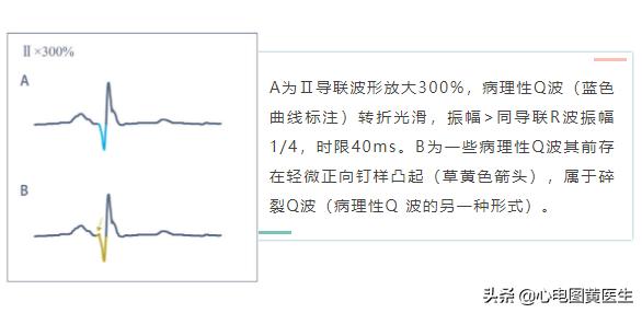 心电图q波异常但冠脉造影正常,病理性q波与异常q波心电图
