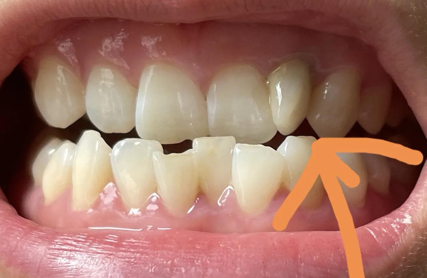 别让“上火”延误您保留牙齿的机会