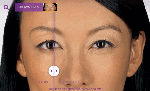 眉间纹很淡打肉毒素打多少,眉间有纹打肉毒素能消除吗