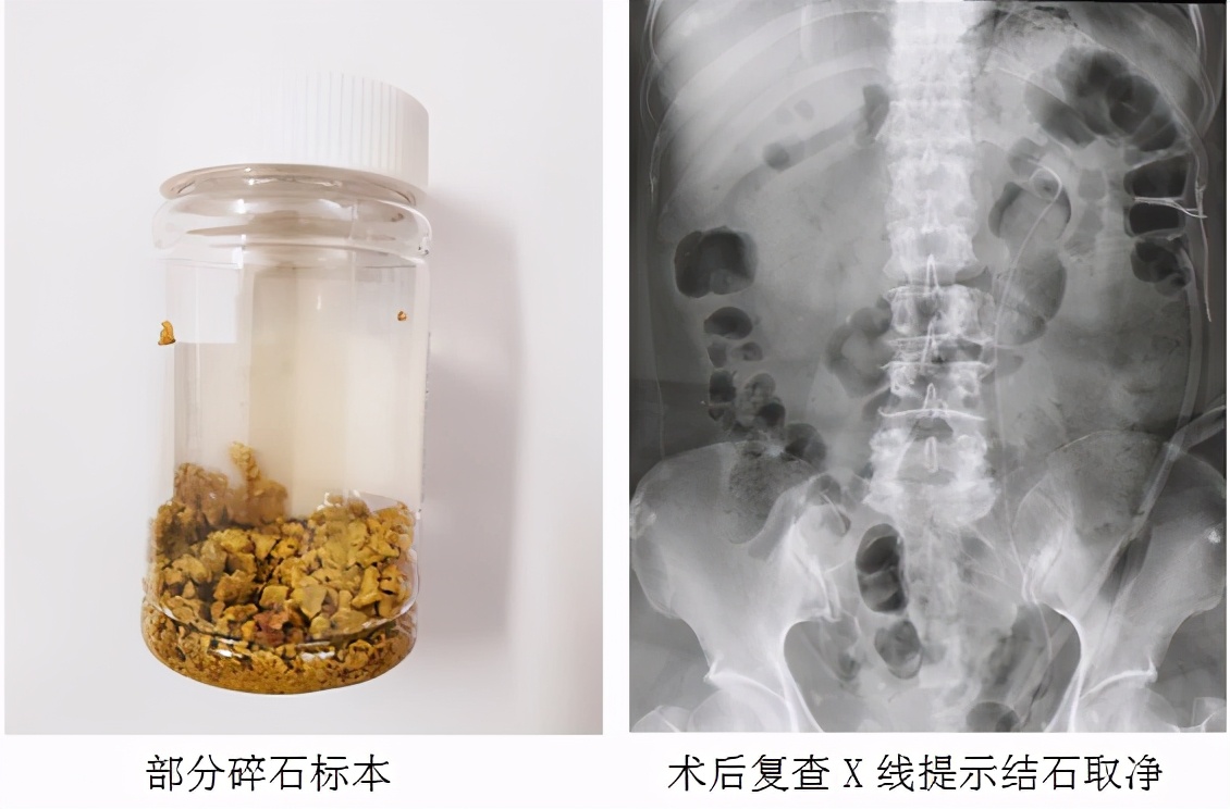 经皮肾镜碎石手术取出的结石,经皮肾镜碎石取石术的病历