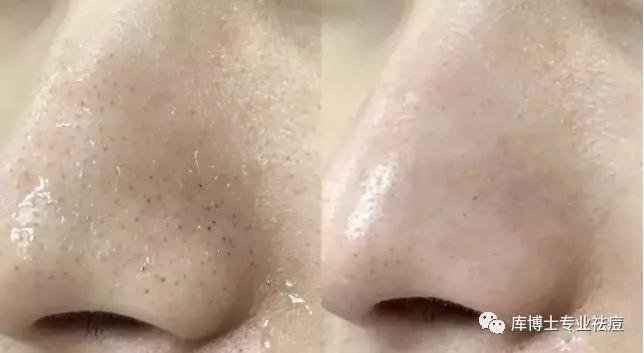 黑头闻起来很臭,黑头很痛怎么回事