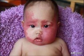 草莓斑胎记,草莓血管瘤胎记