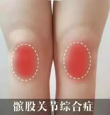 跑步膝盖疼怎么快速缓解,跑步膝盖疼怎么办快速消除