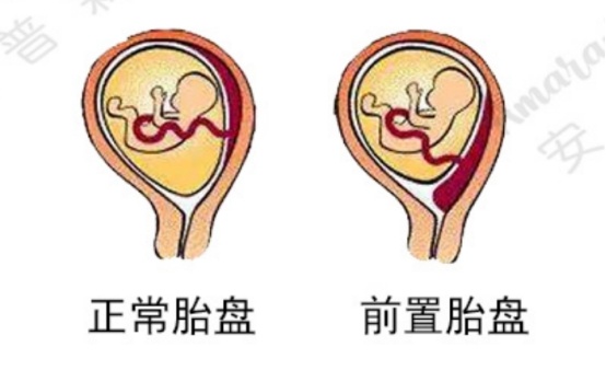 VIDA·READY孕妈课堂:胎盘前置,尤须警惕