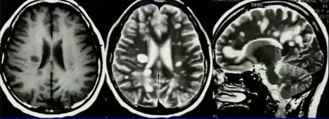 脱髓鞘病变是什么病怎么读,脱髓鞘病变的特征