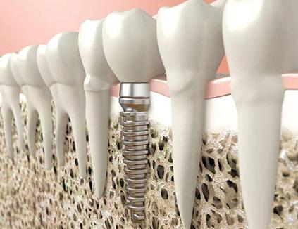 一个牙医对种植牙的良心忠告,种植牙太可怕了真不知道该怎么办