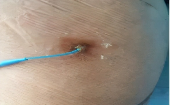 碘伏治疗伤口吗,碘伏治疗伤口发炎吗