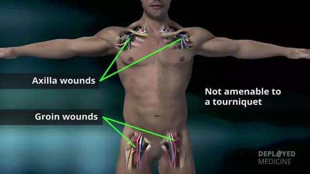 突破传统止血局限：美军战场止血利器X-stat