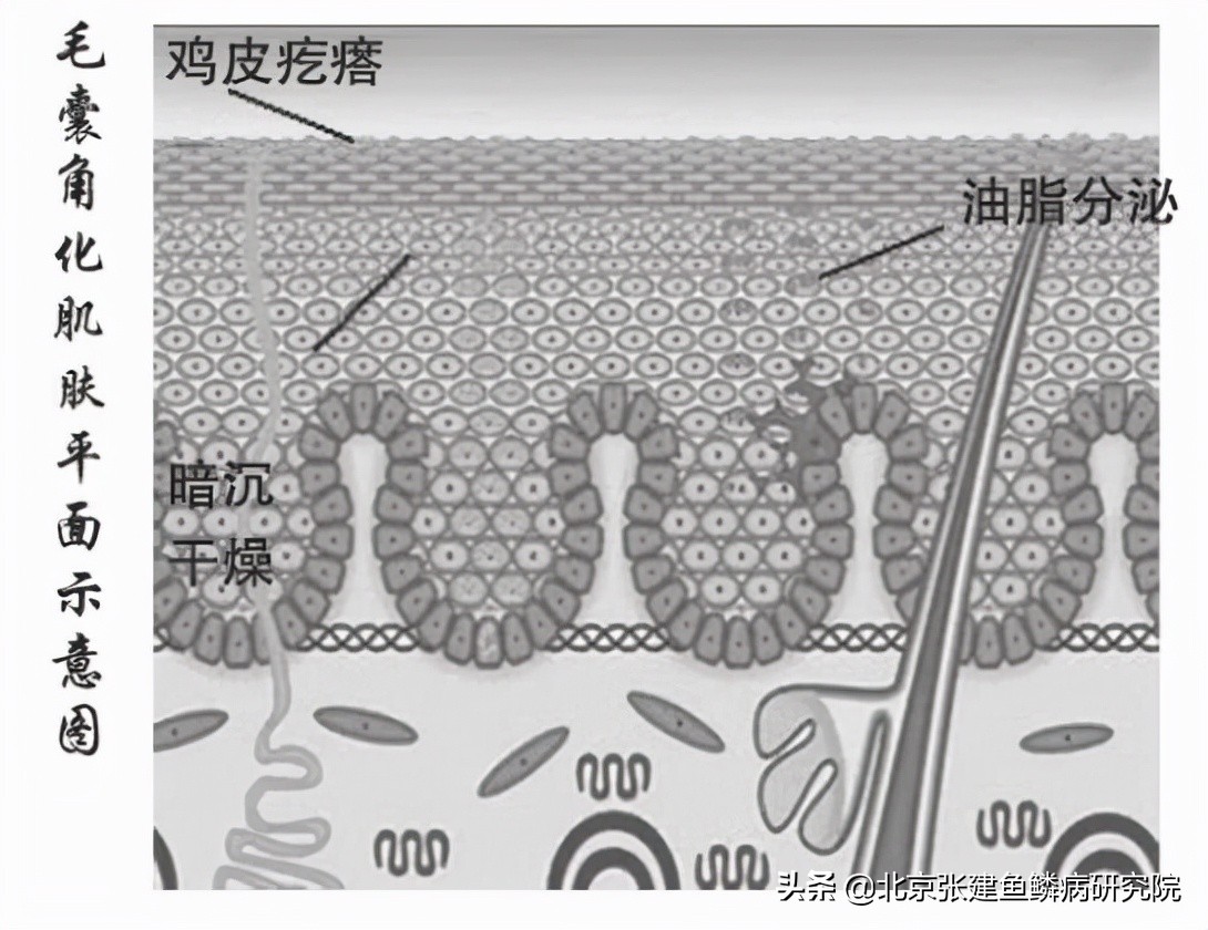 什么样的是毛囊角化症,怎么辨别毛囊是否坏死