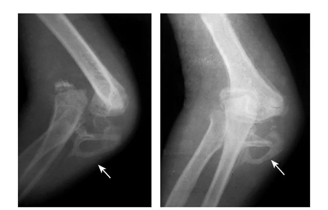 青少年肘部损伤最常见的是,肘部桡神经损伤的临床表现