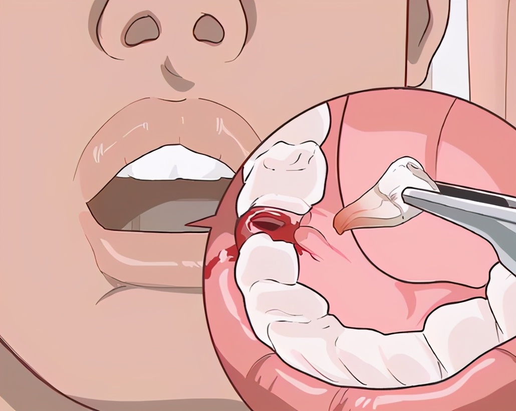 请问医生拔牙后注意什么,拔牙后需要注意哪些事项和禁忌